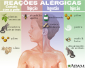 Reações alérgicas