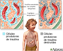 Diabetes tipo 1