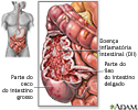 Doença inflamatória intestinal
