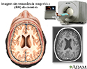 Ressonância magnética do cérebro