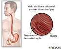 Gastroscopia