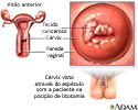 Câncer cervical