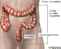 Colite ulcerativa