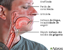 Anafilaxia