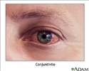 Conjuntivite