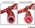Bronquíolo normal versus asmático