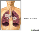 Fumo passivo e câncer de pulmão