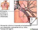 Causas da bronquite crônica