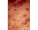 Leucemia monocítica aguda - pele