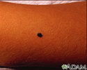 Melanoma juvenil benigno