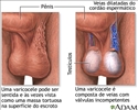 Varicocele