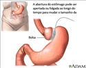 Banda gástrica ajustável