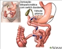 Derivação biliopancreática com switch duodenal