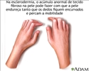 Esclerodactilia