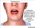 Telangiectasia