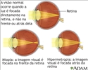 Visão normal, miopia e hipermetropia