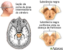 Substância negra e mal de Parkinson
