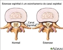 Estenose espinhal