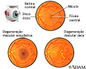 Degeneração macular