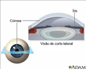 Cirurgia ocular a laser (LASIK) - série