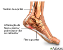 Fascite plantar
