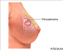 Fibroadenoma
