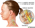 Lesão na medula espinhal