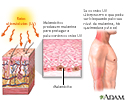 Queimadura solar