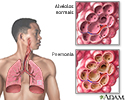 Pneumonia