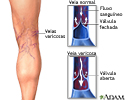 Varizes
