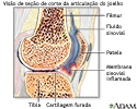 Artrite reumatoide