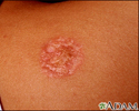Necrobiosis lipoidica diabeticorum - abdome