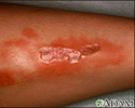 Necrobiosis lipoidica diabeticorum - perna
