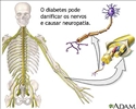 Diabetes e danos aos nervos