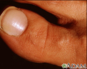 Síndrome da unhas brancas