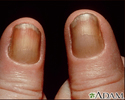 Síndrome da unhas amarelas