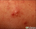 Acne - imagem aproximada das lesões pustulosas