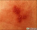 Herpes simples - imagem aproximada