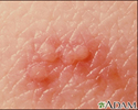 Herpes-zóster (Cobreiro) - imagem aproximada da lesão