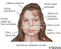 Síndrome alcoólica fetal