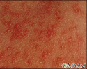 Eritema tóxico neonatal - imagem aproximada