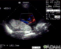 Ultrassom colorida - cordão umbilical normal
