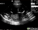Ultrasom, feto normal - ventrículos cerebrais