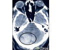 Hemorragia intracerebelares - TC