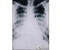 Catapora, pneumonia aguda - raio X do tórax