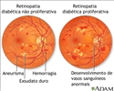Retinopatia diabética
