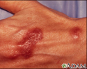 Infecção por Mycobacterium marinum na mão