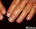 Unhas pela metade