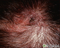 Tinha, tinea capitis - imagem detalhada