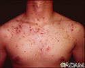 Acne cística no tórax